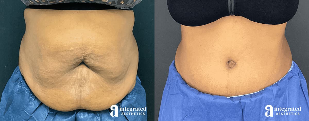 Tummy Tuck Before and After Patient Results