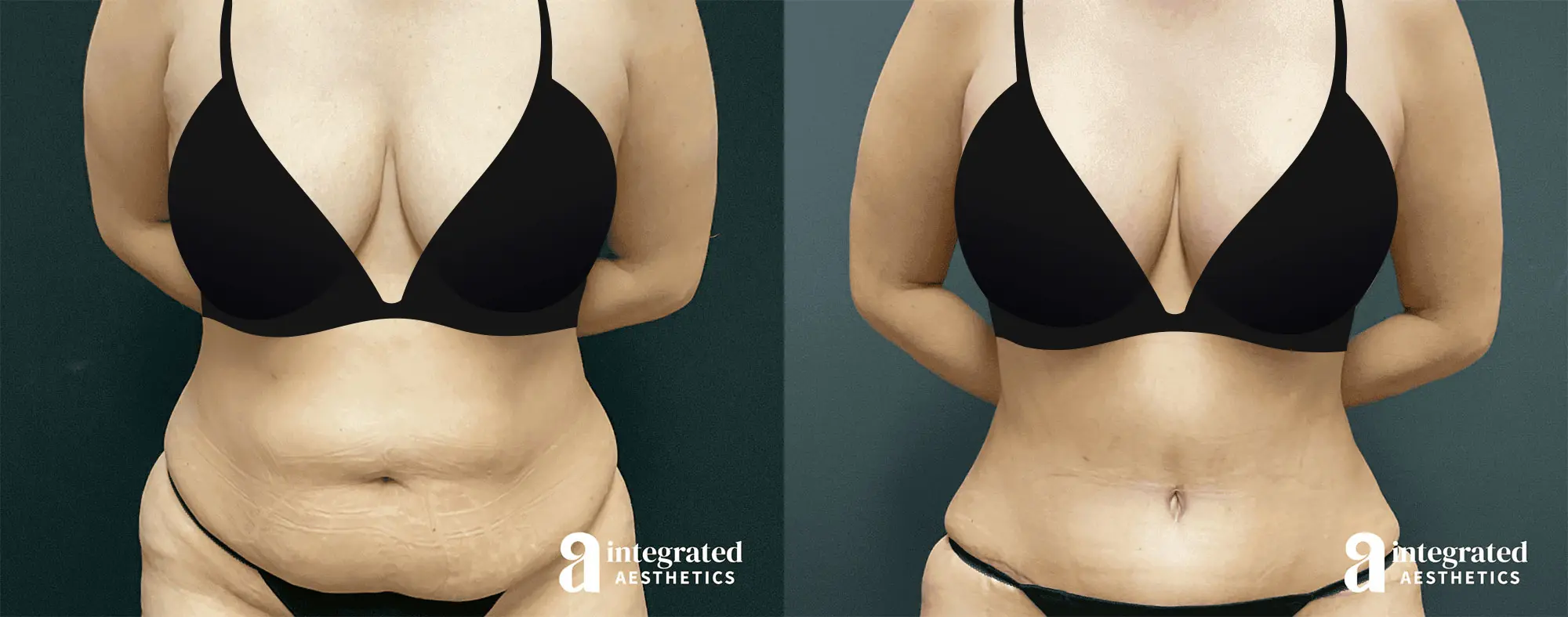 Mommy Makeover Before and After Patient Results