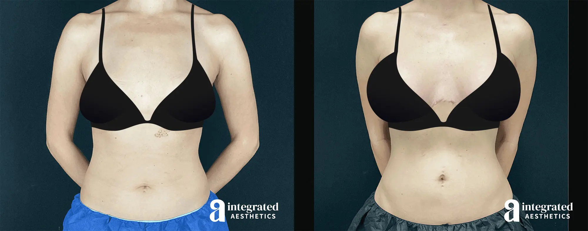 Mommy Makeover Before and After Patient Results