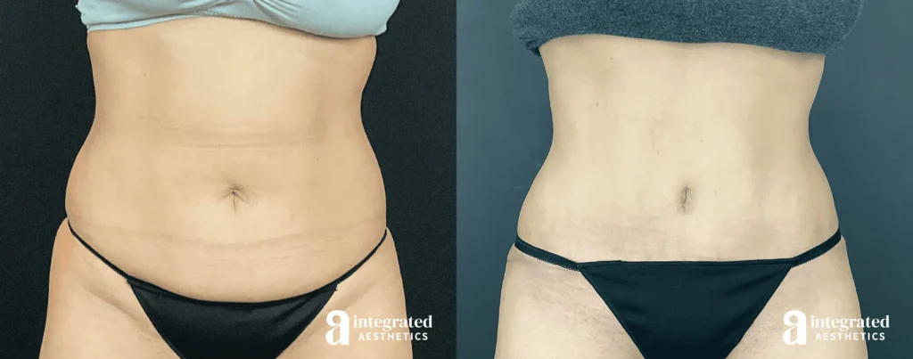 Tummy Tuck - Before and After Patient Results