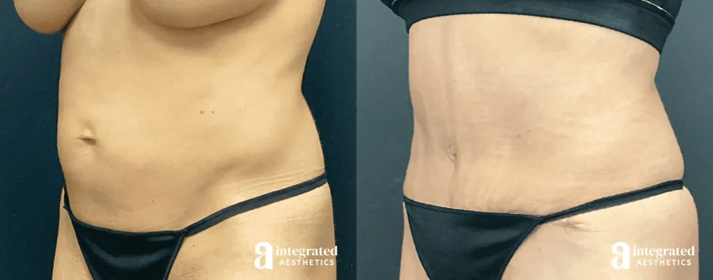 Tummy Tuck - Before and After Patient Results